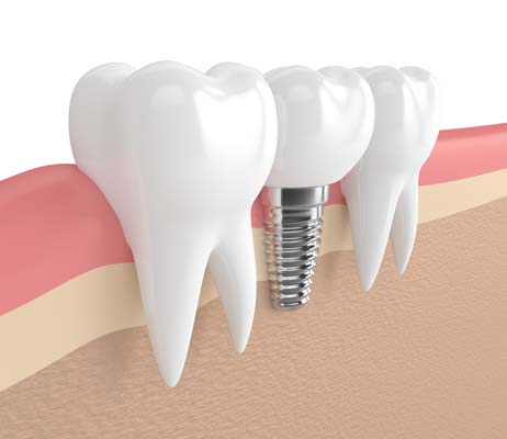 Why Dental Implants Are Good For Your Health