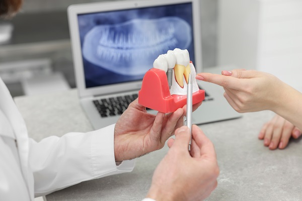 Are There Age Restrictions For Dental Implants?