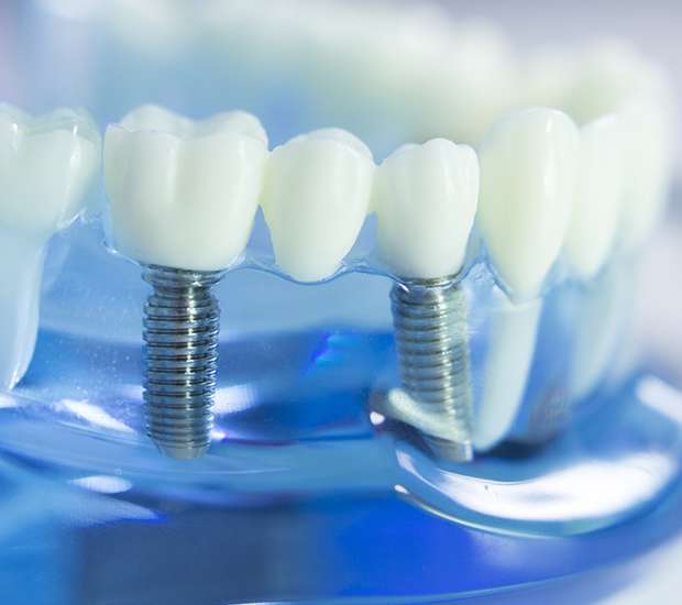 Castle Rock Dental Implants