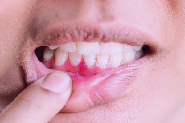 Important FAQs About Gum Disease