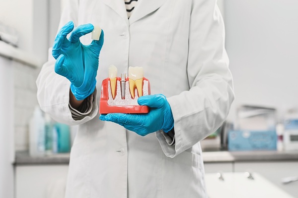 The Difference Between Traditional Crowns And Implant Crowns