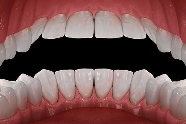 The Link Between Bleeding Gums, Plaque, Bacteria, And Gingivitis