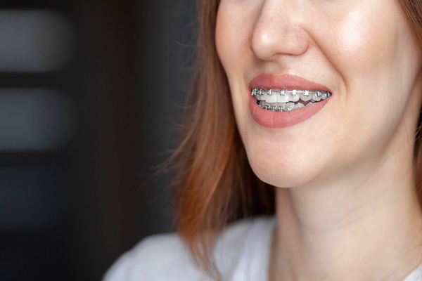 The Complete Guide To Teeth Straightening For Adults